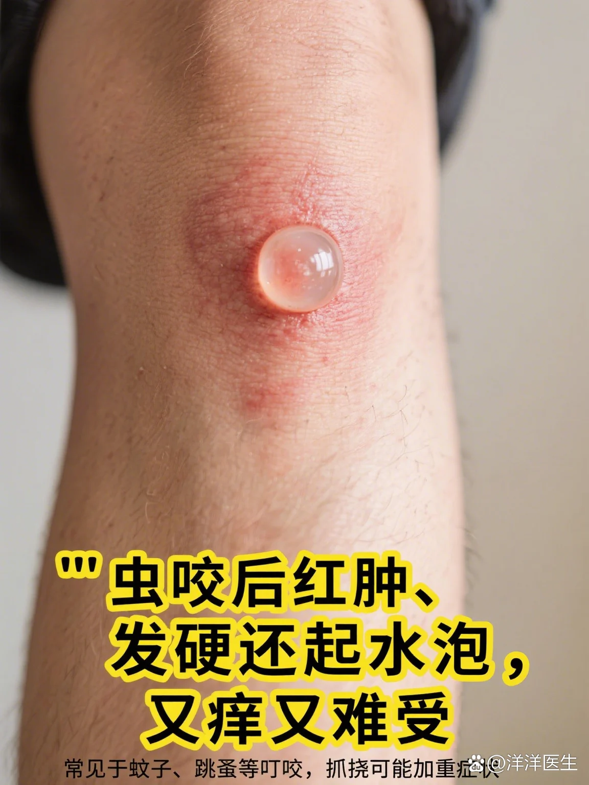脚部水疱虫咬水泡处理