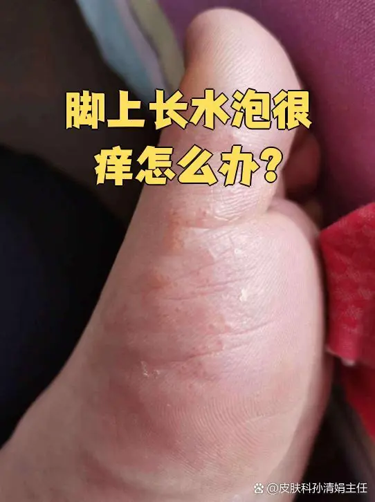 脚部水疱过敏水泡修复