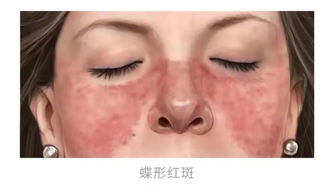 红斑脚气愈后防复发治疗(图1) 红斑脚气愈后防复发治疗
