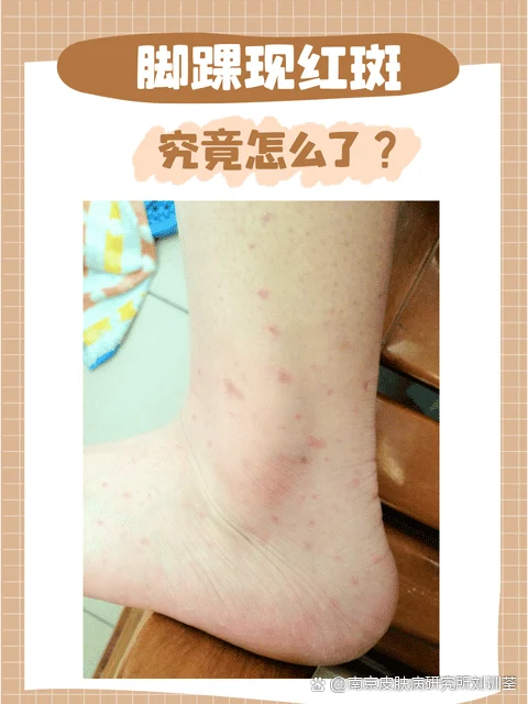 脚部红斑治疗期间防护要点(图1) 脚部红斑治疗期间防护要点
