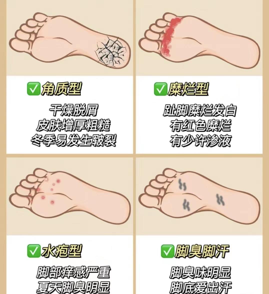 脚部糜烂防止复发快速调理技巧(图1) 脚部糜烂防止复发快速调理技巧
