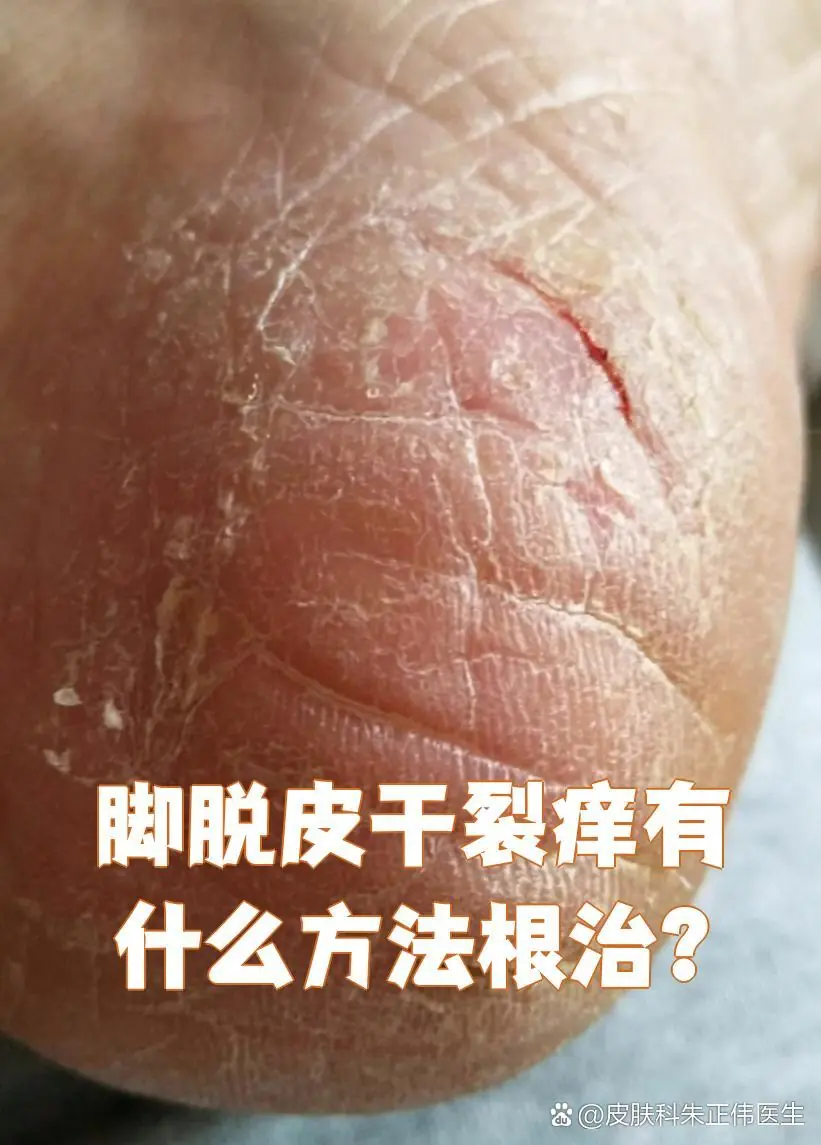 燥热体质脚皮干裂脱皮