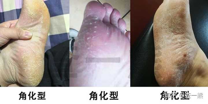 水疱型脚气老旧角质定期清理(图1) 水疱型脚气老旧角质定期清理