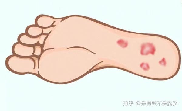 泡脚时间过长引发脱屑
