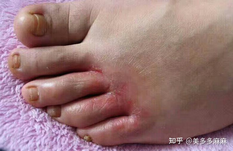 糜烂型脚气日常防护细节(图1) 糜烂型脚气日常防护细节